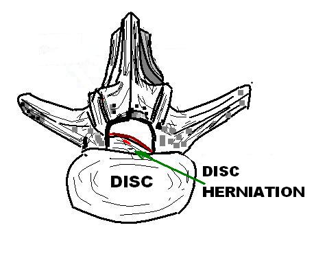 Bel fıtığı anatomisi; omurlar arası diskin sinir köküne doğru taşmasını gösteren tıbbi çizim