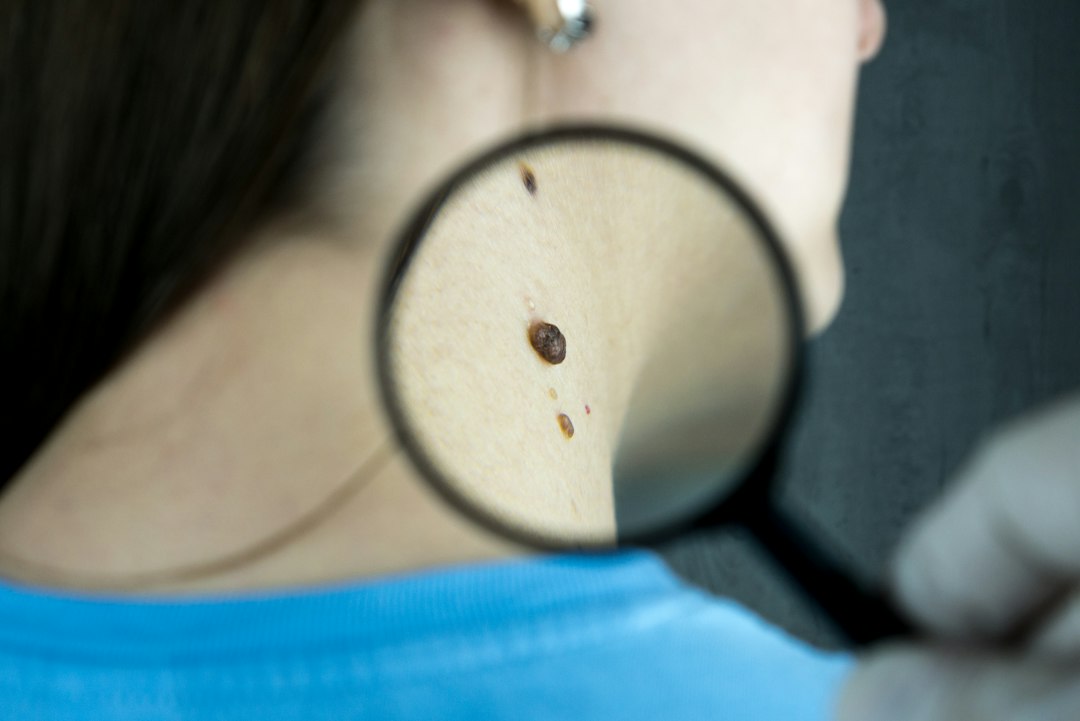 Benlerde değişiklik ve melanoma açısından dermatoloji muayenesi; EPC Hastanesi ben kontrolü bilgilendirme görseli