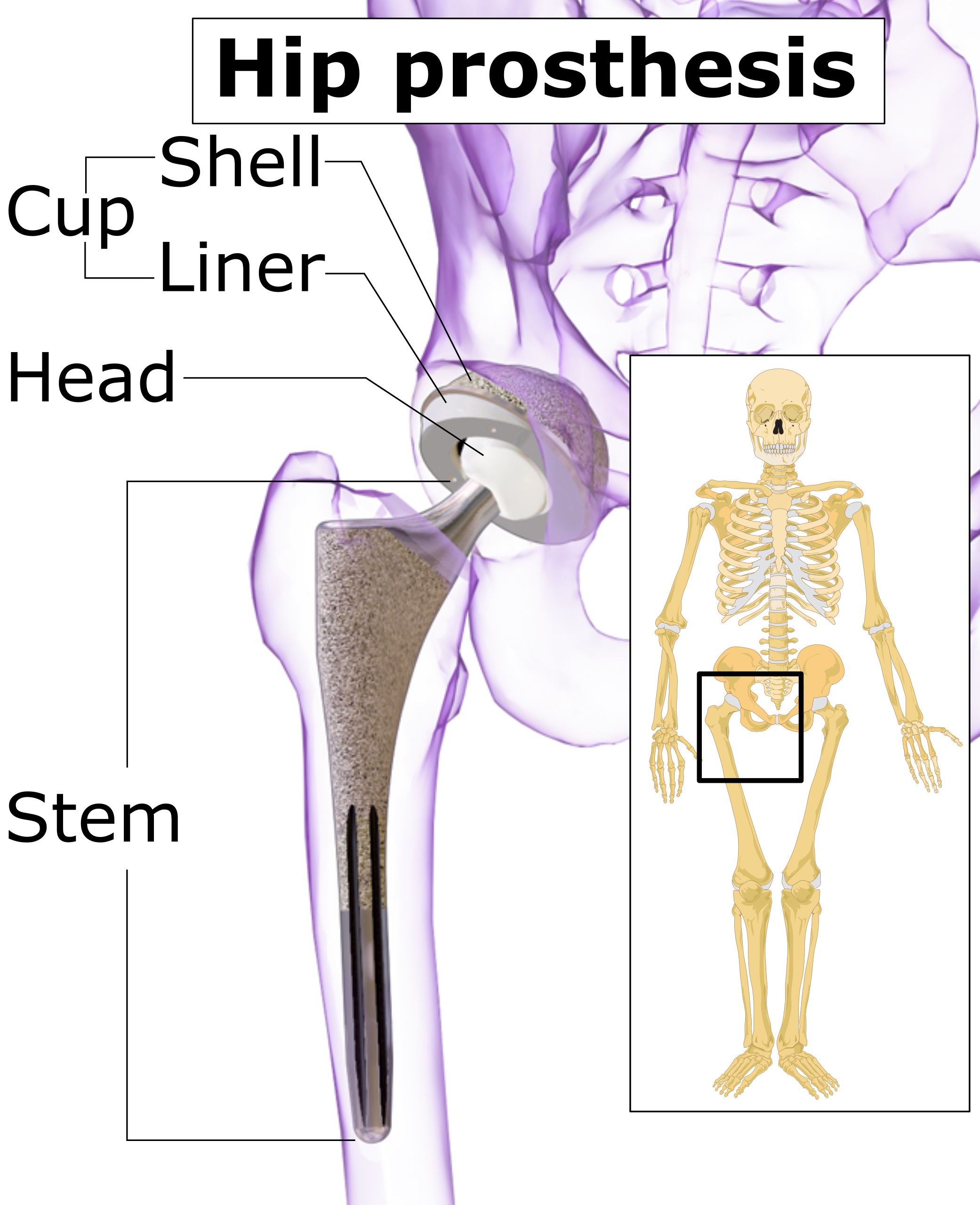 Kalça protezi bileşenlerini gösteren tıbbi çizim; asetabular kap, baş ve femoral stem yapıları