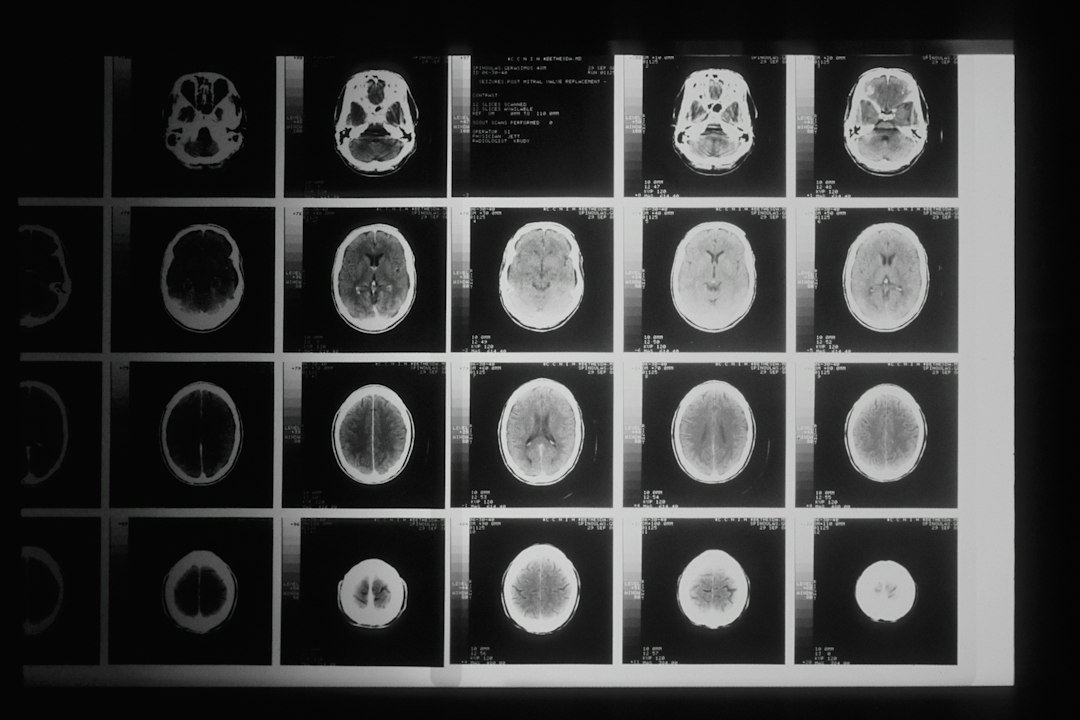 Serebral BT anjiyo ve beyin damarlarının bilgisayarlı tomografi ile görüntülenmesi hakkında EPC Hastanesi bilgilendirme görseli